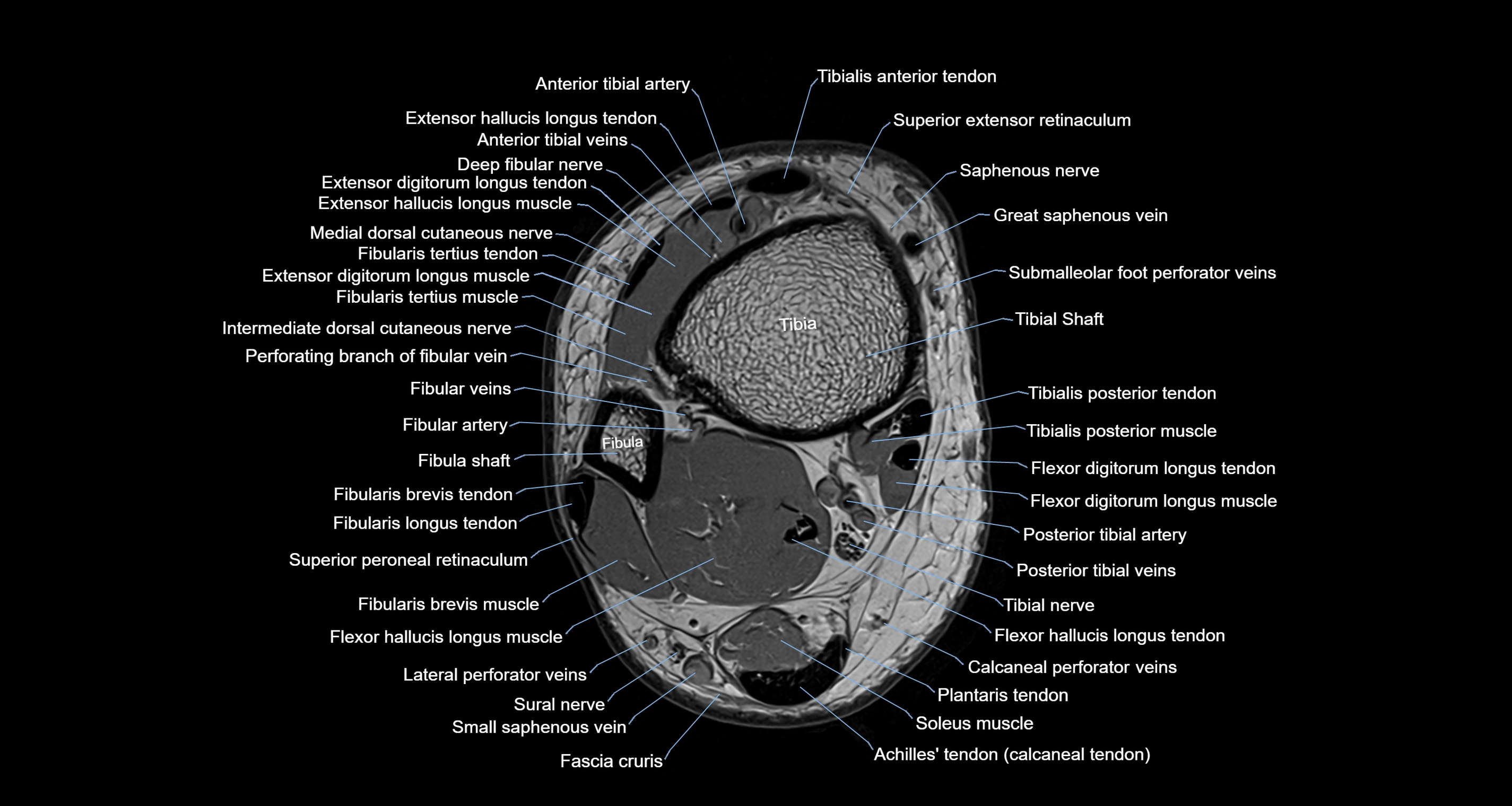 Ankle axial anatomy 3T MRI images -img-10001-00002.webp